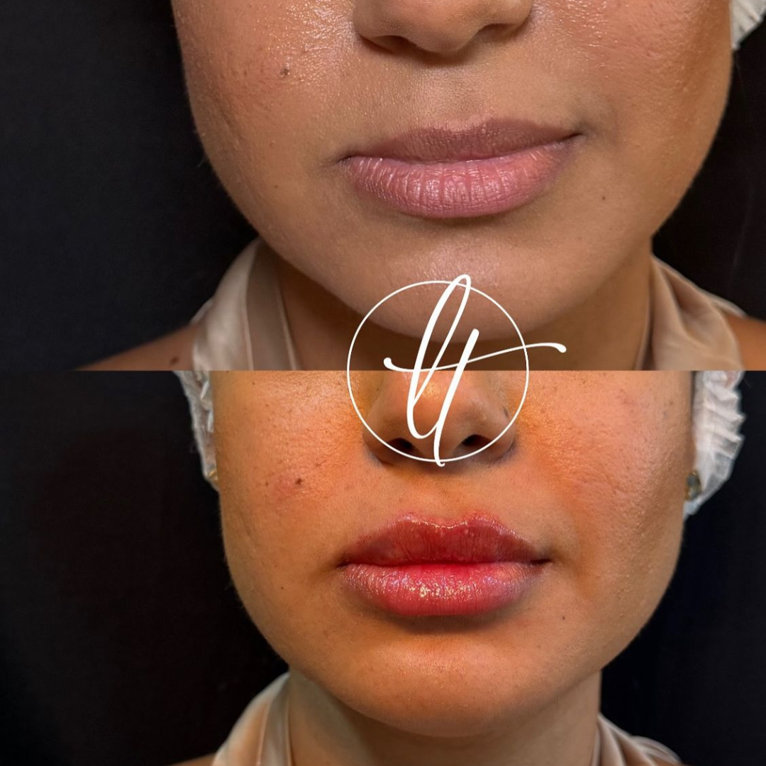 Especialista em harmonização facial (1)